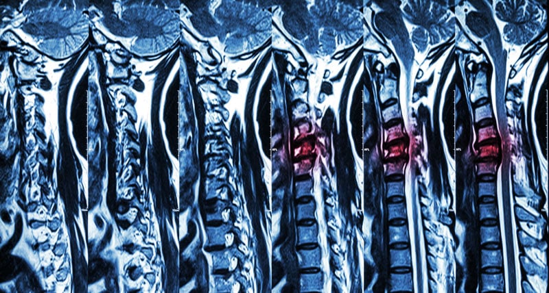 cervical-disc-herniation