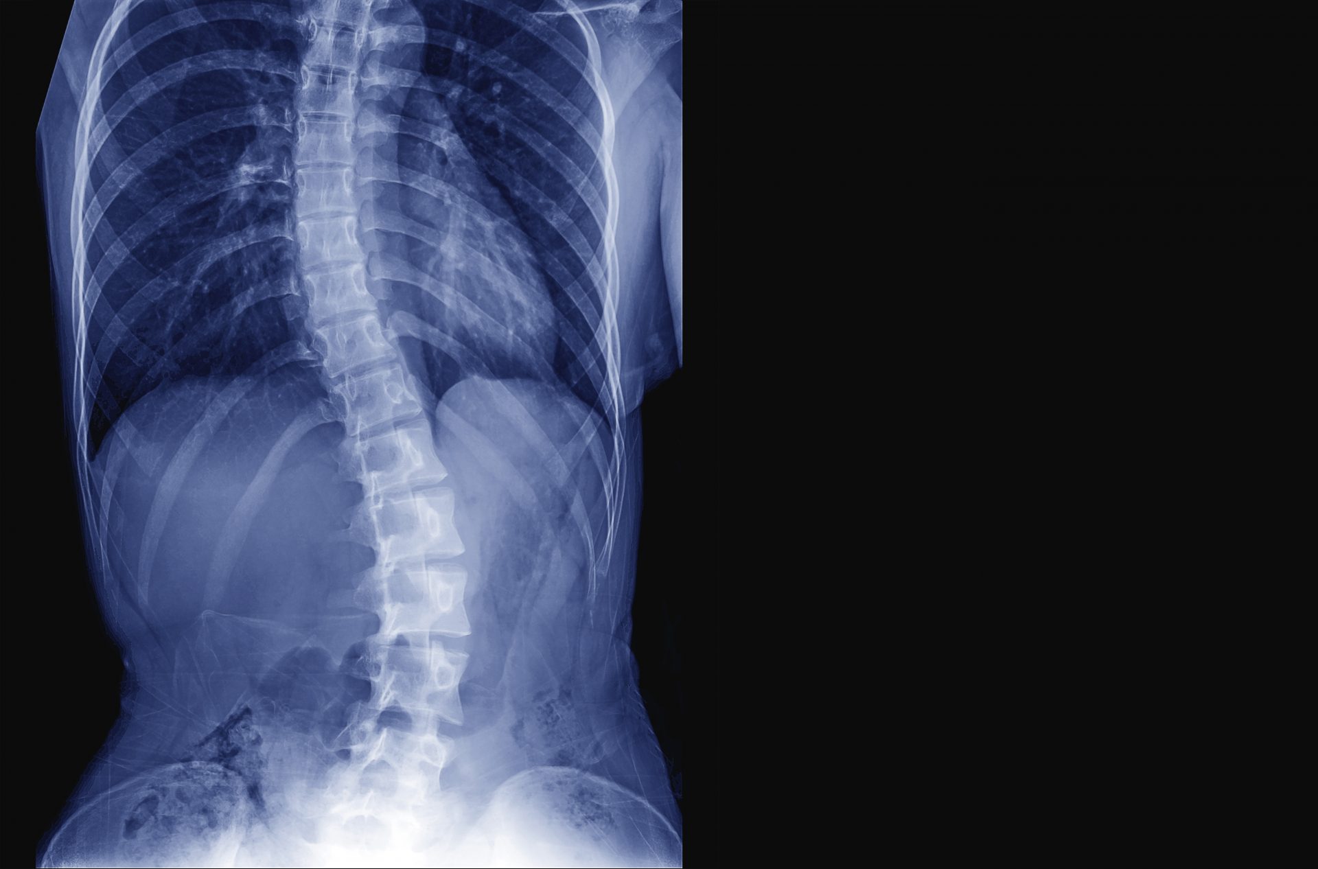 spinal deformities-scoliosis